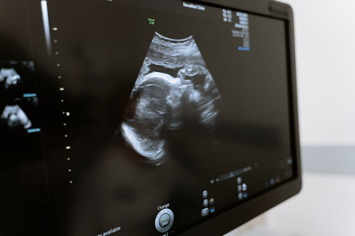 Ultrasound scan image showing detailed baby anatomy at 20 weeks